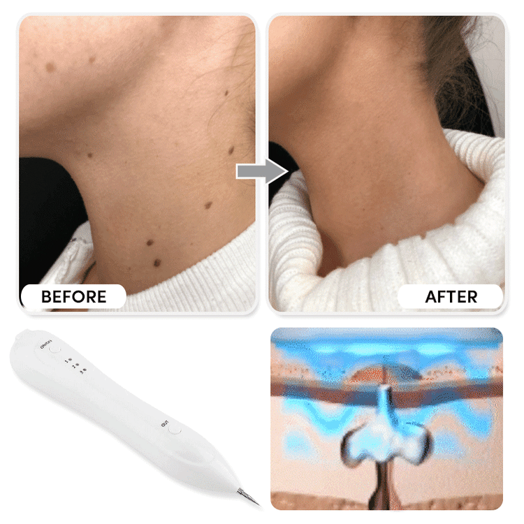 🔥🔥55% off - electric derma beauty pen
